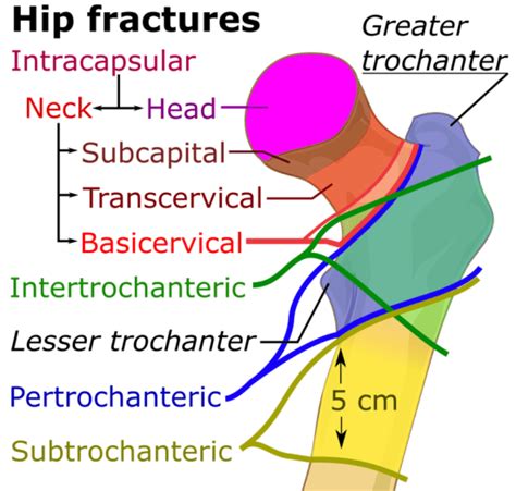 What is the Difference Between Intracapsular and Extracapsular Fracture of Neck of Femur ...