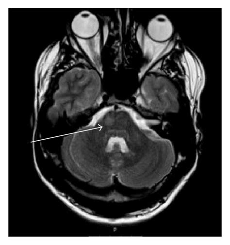 MRI scan of brain. MRI of brain. Axial T2-weighted image showing T2... | Download Scientific Diagram