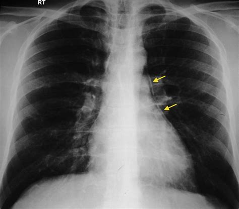 Pneumomediastinum - Radiology at St. Vincent's University Hospital