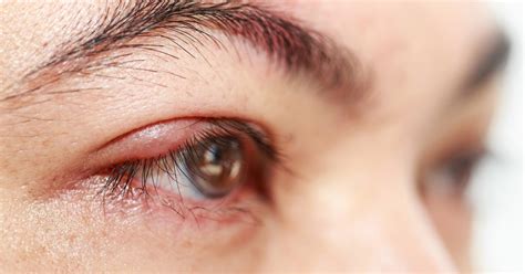 What Causes White Bump on Eyelid? Easy Tips and Treatment Advice