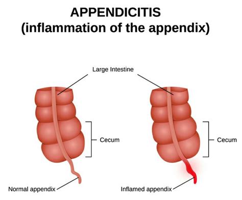 Appendicitis – Inflammation Of The Appendix | MedicineBTG.com