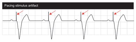 Interpretation of Pacemaker ECG – Cardiovascular Education