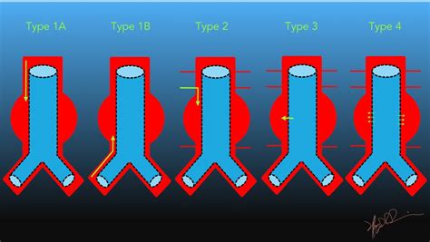 Classification of Aortic Stent-Graft Endoleaks | UW Emergency Radiology