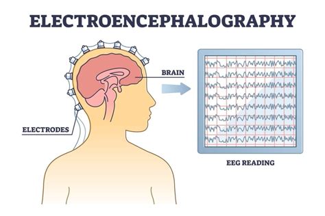 What Does An Eeg Tell The Doctor at Mary Michel blog