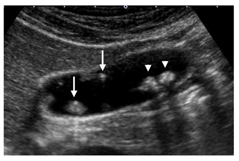 Gallbladder Ultrasound