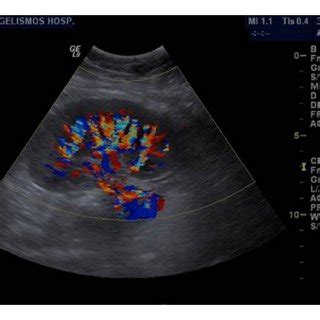 Spectral Doppler ultrasound image shows a tardus parvus waveform in an... | Download Scientific ...