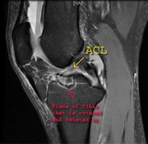 Follow-up MRI on tibial eminence fx X-rays. With Arrows : r/Radiology