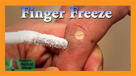 Finger Wart Cryotherapy Probe | Auburn Medical Group - YouTube