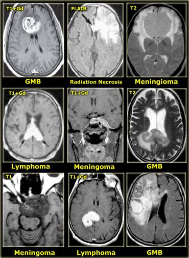 The Radiology Assistant : Systematic Approach to Brain Tumors