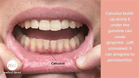 Calculus causes gingivitis and periodontitis - Method Dental