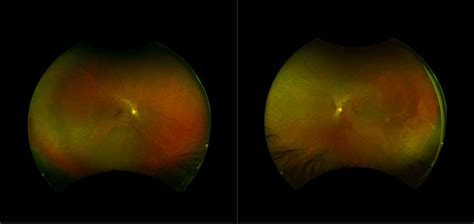 Mild Nonproliferative Diabetic Retinopathy