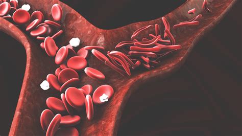 Anemia Falciforme ou Doença Falciforme: saiba o que é e como pode ser diagnosticada e tratada ...