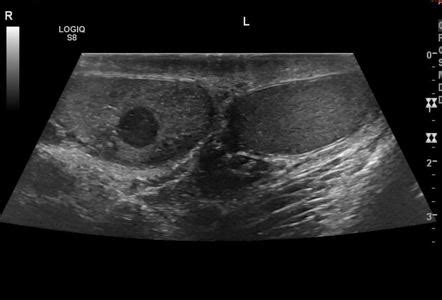 Testicular Seminoma Ultrasound