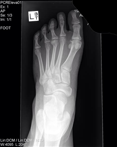 X-ray left foot - metatarsal pain : Radiology