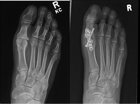 Metatarsophalangeal Joint Fusion | Hot Sex Picture