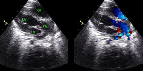 Modified PLAX view in TGA - Transposition of great arteries