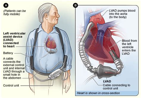 LVAD Management In The ED — NUEM Blog