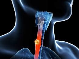 Stage 4 esophageal cancer diagnosis - PeopleBeatingCancer