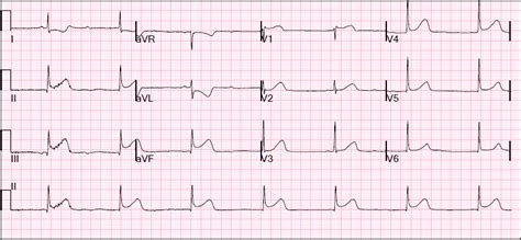 Dr. Smith's ECG Blog: Inferior STEMI with AV Block, Cardiogenic Shock ...