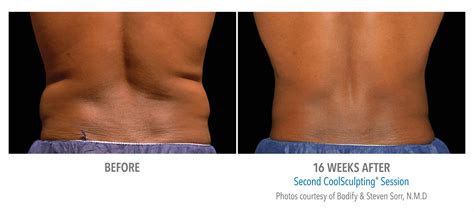 CoolSculpting for Men Near Me | CoolSculpting Stomach | Male CoolSculpting Chest