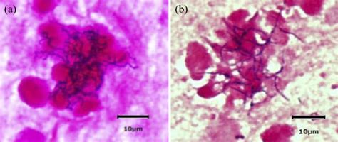 Figure1.A Gram stain of the sputum in 2013 showed branching... | Download Scientific Diagram