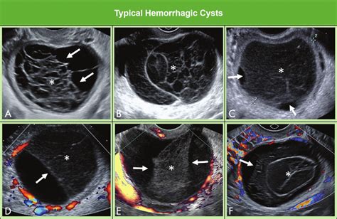 Images show typical hemorrhagic cysts. A, Ovarian hemorrhagic cyst with... | Download Scientific ...