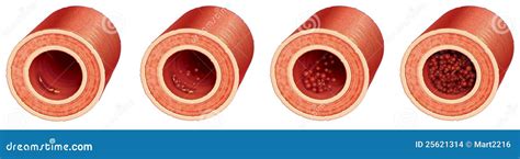 Thrombus Formation Vector Illustration | CartoonDealer.com #25621314