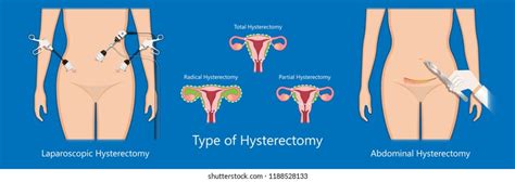 43 Subtotal Hysterectomy Images, Stock Photos & Vectors | Shutterstock