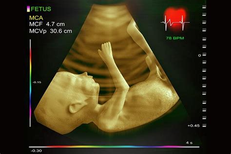 What Is Fetal Echocardiogram And Why Is It Done?