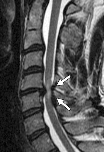 Nontraumatic Spinal Cord Compression: MRI Primer for Emergency Department Radiologists ...