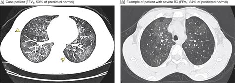 Bronchiolitis Obliterans After Allogeneic Hematopoietic Stem Cell Transplantation | Pulmonary ...