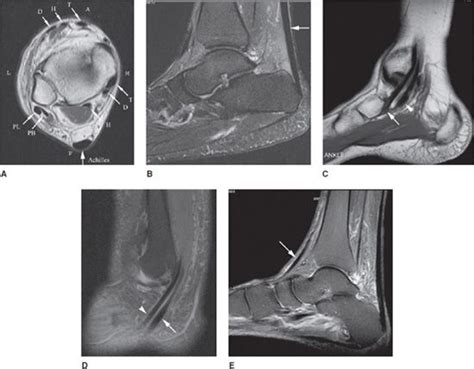 Ankle MRI | Radiology Key