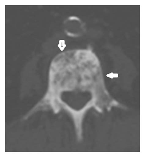 A case of prostate cancer with osteoblastic metastasis. (a, b) CT scan... | Download Scientific ...