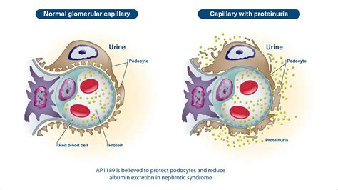 Membranous Nephropathy – SynAct Pharma