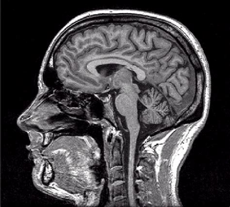 Sagittal magnetic resonance imaging (MRI) image of a human head... | Download Scientific Diagram