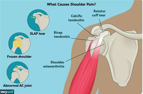 Causes of Shoulder Pain and Treatment Options - Sports Medicine Weekly ...