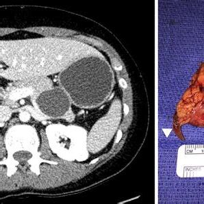 IPMN-associated pancreatic cancers tend to have a better prognosis... | Download Scientific Diagram