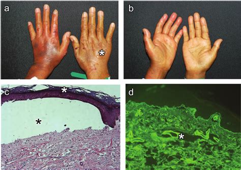 Pseudoporphyria in a haemodialysis patient. ( a , b ) Blisters (white... | Download Scientific ...