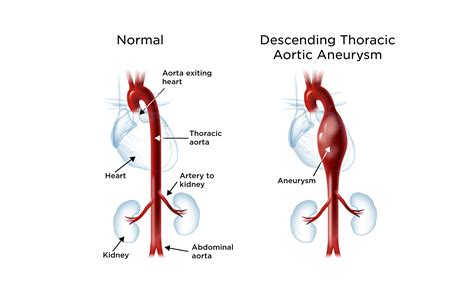 Ascending And Descending Aorta