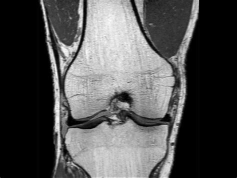 Comprehensive 3D knee imaging with MSK VIEW | Philips MR Body Map