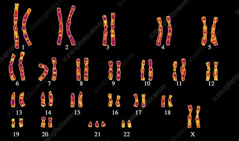 Down's syndrome karyotype - Stock Image - C001/8378 - Science Photo Library