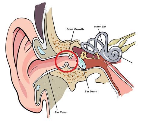 Hydro Surf Shop - Blog | What Is Exostosis (Surfers Ear)