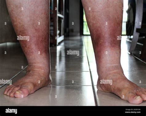 Heaviness in legs hi-res stock photography and images - Alamy