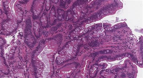 Nonampullary duodenal adenoma | MyPathologyReport.ca