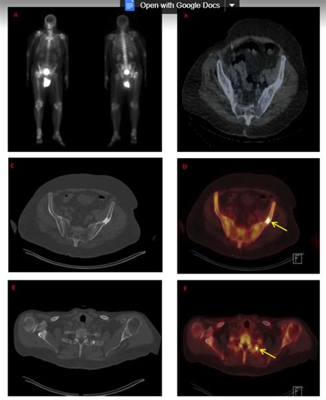 PET/CT for Prostate Cancer: From Diagnosis to Metastasis - ESHIᴹᵀ