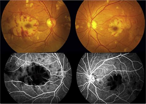 Fundus picture, Fundus Fluorescein Angiography images of both eyes at... | Download Scientific ...