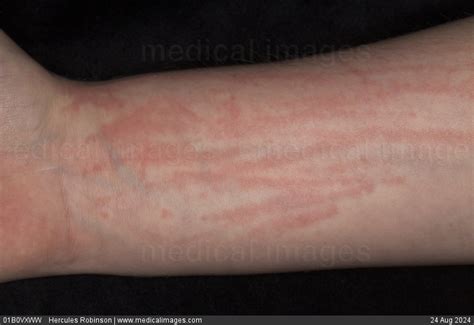 STOCK IMAGE, dermatographism dermatographic urticaria is a skin ...