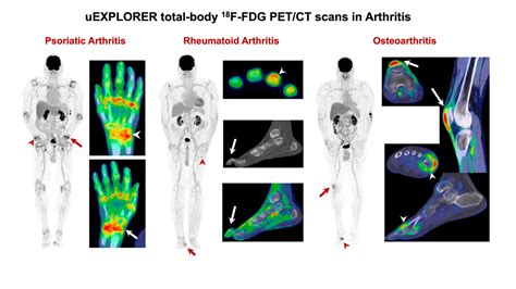 Total-body PET/CT captures full picture of systemic inflammatory arthritis