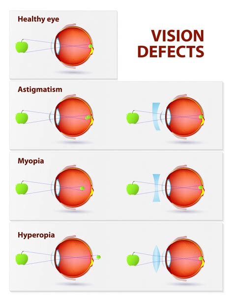 Types Of Vision Problems Refractive Surgery Corrects | RSC