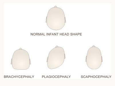 2 Littlefaces: My baby has a lopsided head!